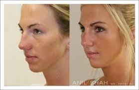 But she too is said to have undergone the knife to tweak her looks. Female Rhinoplasty Patient 3 3 4 View Rhinoplasty Facial Plastic Facial Plastic Surgery