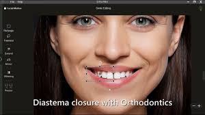 Curious how your new smile could look before starting treatment? Digital  Smile Design uses imaging technology to plan a smile that fits your face.  It involves scanning your teeth and facial features,