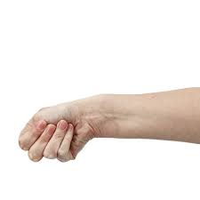 We have also outlined a staged description of this test, which we have found to be reliable and minimally painful for the diagnosis of de quervain's tendonitis within our clinical practice. A Closer Look At De Quervain S Syndrome And Orthotic Management