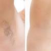 I'm thinking of getting my under arms, brazilian, and possibly my legs lasered. 1