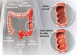 La fatigue et la perte d'appétit sont des symptômes de plusieurs problèmes de santé. Rectocolite Hemorragique Ramsay Sante