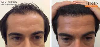 L'alopecia androgenetica femminile e maschile non solo comportano un . Trapianto Capelli Verona Tecnica Autotrapianto Foto E Costi Hsd