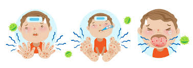Hfmd biasanya bermula dengan demam, rasa tidak sihat yang disusuli dengan penyakit hfmd adalah sejenis penyakit berjangkit. Hfmd Penyakit Tangan Kaki Dan Mulut Hello Doktor