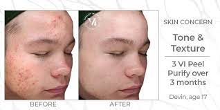 Acne scars before and after chemical peel. Chemical Peels Improves Dullness Acne Wrinkles More Cor Medspa