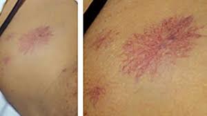 Maybe you would like to learn more about one of these? What Does Hepatitis C Look Like