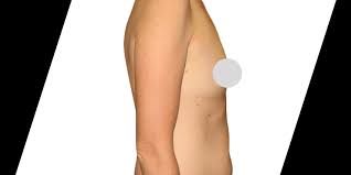 All transfers to / from the airport, hotel and clinic during your stay. 10 Things To Expect After Your Brazilian Butt Lift Surgery Premiere Surgical Arts
