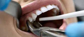 Tooth Extraction When Will Dentists Pull Teeth Dr Varley