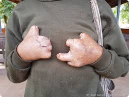 A scurfy, mealy substance on the surface of some plants. Investigacion De La Lepra