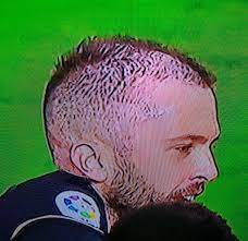 Jordi alba se ha puesto implantes de pelo, y en bajo primera hemos hablado con el doctor para que nos explique de forma. Que Le Pasa A Jordi Alba En El Pelo Amenzing