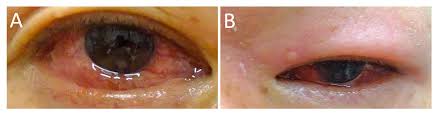 Image result for Relapsing Polychondritis