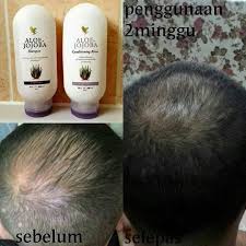 Ini kerana ia boleh mengganggu kelancaran darah serta mengurangkan nutrisi yang membantu menghasilkan rambut yang kuat dan sihat. Botak Bertompok Boleh Sembuh Dengan Cara Ini Ohcantik Com