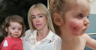 Toddler left scarred for life after 'children bit her 15 times at play  centre'