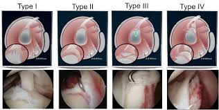 Image result for SLAP Lesion
