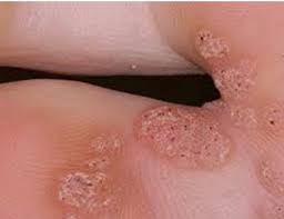 Barko shows us one of the ways to actually get rid of plantar warts for good! Warts Verucca Karr Foot Leg Center