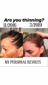 Possible involvement of sulfonylurea receptor 2b as a target of minoxidil. Thinning Hair Solutions From A Shampoo Hair Loss Remedies Women Thin Hair Solutions Botanical Hair Care