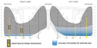 Reviewed by arefa cassoobhoy, md. Lung Ultrasound Pleural Effusion Litfl Ultrasound Library