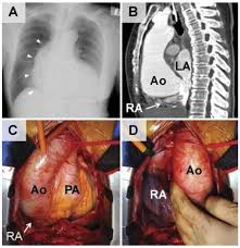 Jcm Free Full Text Platypnea Orthodeoxia Syndrome Multiple Pathophysiological Interpretations Of A Clinical Picture Primarily Consisting Of Orthostatic Dyspnea Html