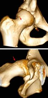 Racgp Hip Pain In Young Adults