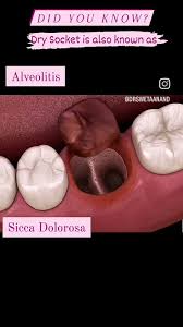 Image result for Alveolitis sicca)