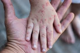 Viral claims about the virus. Cacar Monyet Penyebab Gejala Dan Cara Mengobatinya