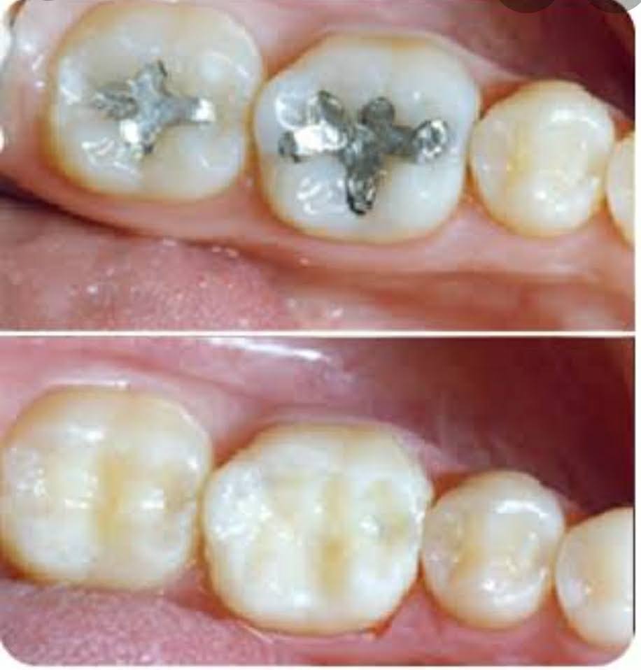 Tooth Colored Filling product image
