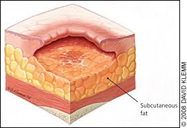 Pressure Ulcers Prevention Evaluation And Management