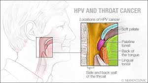 The throat, or pharynx, has many parts, and cancer can develop in most of them. Chemotherapy Drugs For Hpv Throat Cancer Hhh Cervical Cancer Oral Sex Does Hpv Cause Throat Cancer