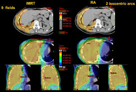 Lippincott journals subscribers, use your username or email along with your password to log in. Volumetric Modulation Arc Radiotherapy Compared With Static Gantry Intensity Modulated Radiotherapy For Malignant Pleural Mesothelioma Tumor A Feasibility Study International Journal Of Radiation Oncology Biology Physics