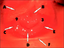 And truthfully speaking, a female will only be concerned about her hymen when it is torn, lacerated, or too thick that it nearly covers the entire vaginal opening. Sexual Abuse In Children American Academy Of Pediatrics