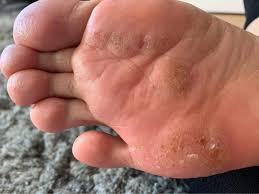 Image result for pompholyx soles of feet