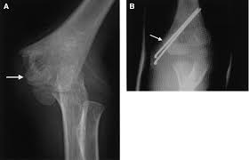 Medial epicondyle fractures represent almost all epicondyle fractures and occur when there is avulsion of the medial epicondyle. Operative Treatment Of Displaced Medial Epicondyle Fractures In Children And Adolescents Sciencedirect