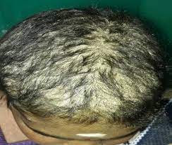 Valitse kuva aakkosellisesta riippuvalikosta tai Pityriasis Amiantacea Mimicking Tinea Capitis Download Scientific Diagram