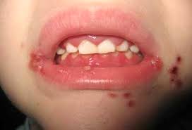 The herpes simplex virus is categorized into 2 types: Clinical Practice Guidelines Hsv Gingivostomatitis