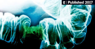 If more than one family member has colon cancer or rectal cancer, your risk is even greater. More Young People Are Dying Of Colon Cancer The New York Times