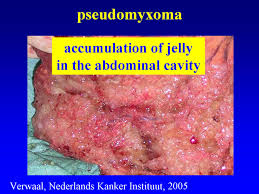 Despite many histopathologic similarities between peritoneal and . Hipec Mesothelioma