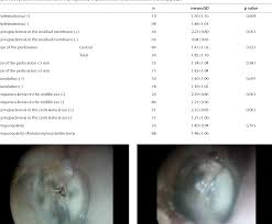 Image result for Myringosclerosis