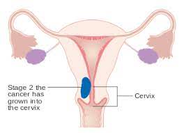 एन्डोमीट्रीओसिस (endometriosis meaning in hindi) एक. Endometrial Cancer Wikipedia