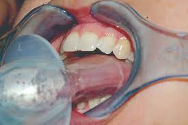 The aveotsd is made from a soft medical silicone for comfort and works by holding the tongue forward by gentle suction preventing it from falling back against the. Part Ii Introduction To Sleep Disordered Breathing Inside Dental Technology July 2016 Rn Cdeworld