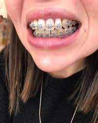 ¿usted ha oído que ahora puede elegir entre varios colores de brackets cierto?. Pin On Mouth Braces