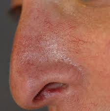 Demodex folliculorum peut représenter un cofacteur important, particulièrement en cas de rosacée. Couperose Rosacee Rougeurs Dr Jean Claude Katz Dermatologue