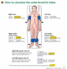 Using The Ankle Brachial Index To Diagnose Peripheral Artery