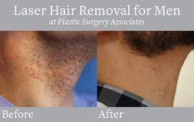 Pin On At Home Beauty Acne Hair Removal