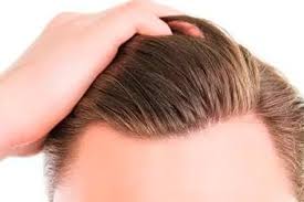 Sei di torino e sei vuoi la correzione della calvizie con il trapianto capelli esclusivo micro fue? Trapianto Capelli Medicina E Chirugia Estetica In Abruzzo Dr Donato Zizi