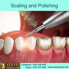Dental Scaling Polishing Dental Dental Care Dental Hospital