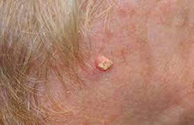 Prostate cancer is a common type of cancer in men, according to the mayo clinic. Types Of Skin Cancer Arizona Skin Cancer Specialists