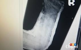 Saat kuelus punggungnya, tante yana mendongakkan kepalanya dan terengah. Tangan Atau Kaki Patah Apa Akibat Jika Tidak Dibawa Ke Hospital Free Malaysia Today Fmt