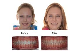 Maybe you would like to learn more about one of these? How Clear Braces Are Helping Canadians Smile With Confidence