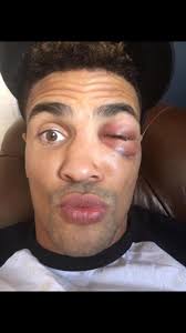 Two years ago today I suffered the worst injury of my life, an eye socket  that had “exploded” as one doctor eloquently put it to me. Multiple  fractures sustained as well as