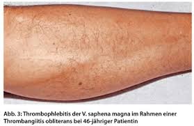 Thrombose ist der medizinische begriff für ein blutgerinnsel in einem blutgefäß. Thrombophlebitis Besser Nicht Unterschatzen Doctors Today