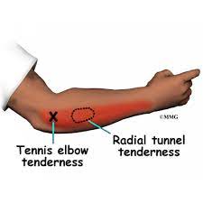 Here's what you need to know about tennis elbow, a common form of tendonitis that has little to do with tennis. Lateral Epicondylitis Tennis Elbow